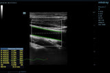 Mindray ZONE Sonography® Technology