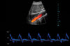 Mindray TE X Portable Ultrasound System