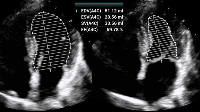 Mindray MX8 Portable Ultrasound Machine