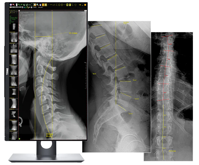 20/20 CFPW Wireless 14x17 CHIROPRACTIC Direct Digital Imaging System - DR Panel