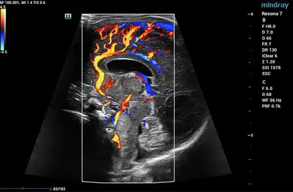 Mindray Resona 7 Platinum Edition Ultrasound System