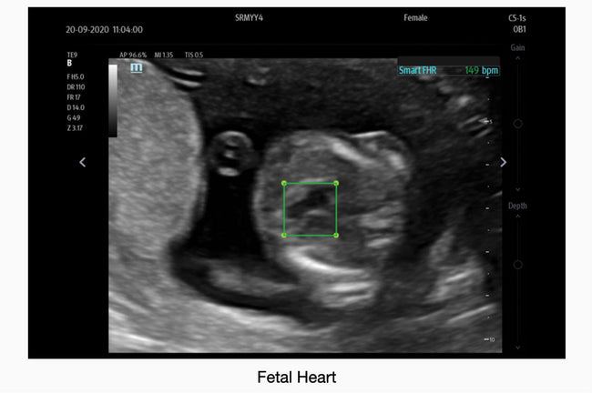 Mindray TE7 Max Point of Care Ultrasound