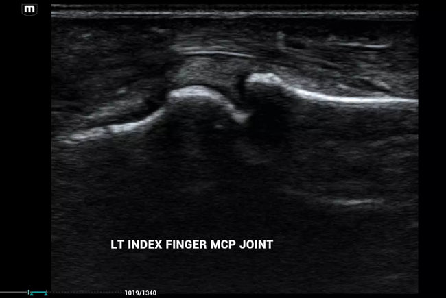 Mindray MX8 Portable Ultrasound Machine