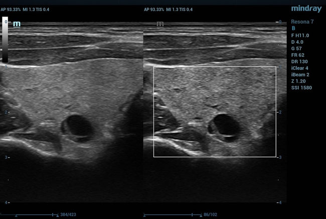 Mindray ZONE Sonography® Technology