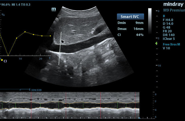 Mindray M9 Premium Ultrasound System