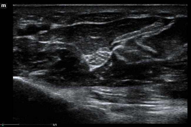 Mindray MX8 Portable Ultrasound Machine