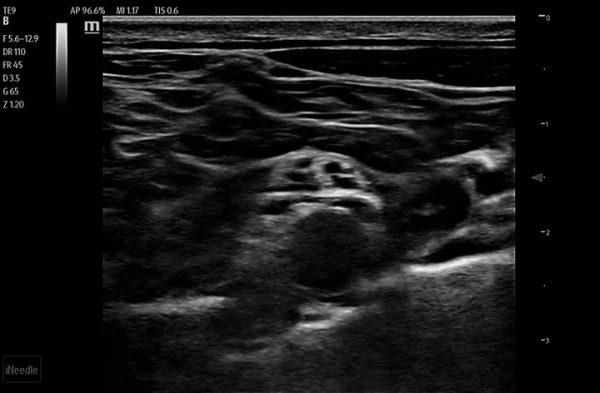 Mindray TE7 Max T Ultrasound