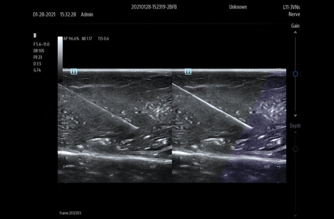 Mindray TE5 SP Point of Care Ultrasound Machine