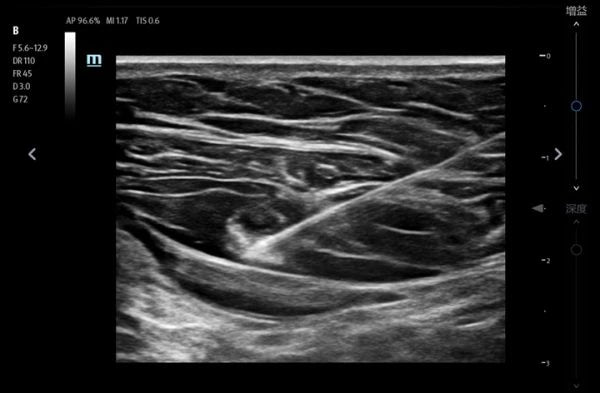 Mindray TE7 Max T Ultrasound