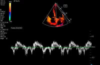 Mindray TE7 Ultrasound System Crystal Series 2.0
