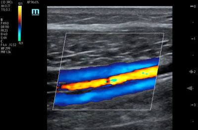 Mindray TE7 Ultrasound System Crystal Series 2.0