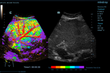 Mindray ZONE Sonography® Technology