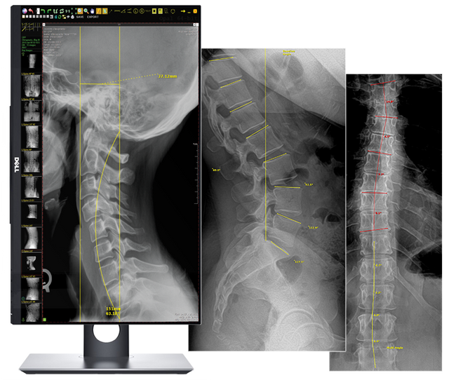 20/20 CFPH Hybrid 17x17 Chiropractic Direct Digital Imaging System - DR Panel