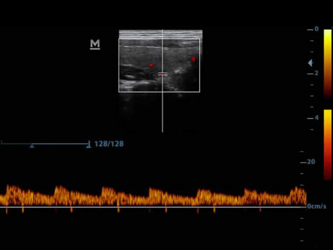 Mindray DP-30 Power Ultrasound Imaging System (72-Month Subscription)
