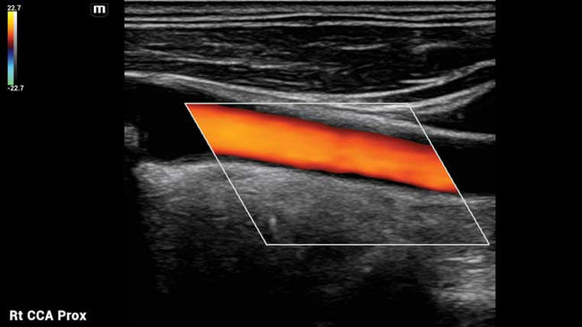 Mindray MX8 Portable Ultrasound Machine