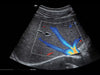 Mindray MX7 Laptop Ultrasound Machine