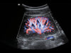 Mindray MX7 Laptop Ultrasound Machine