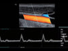 Mindray MX7 Laptop Ultrasound Machine