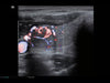 Mindray MX7 Laptop Ultrasound Machine
