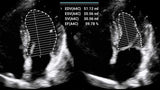 Mindray MX8 Portable Ultrasound Machine