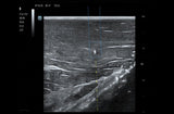 Mindray TE5 SP Point of Care Ultrasound Machine